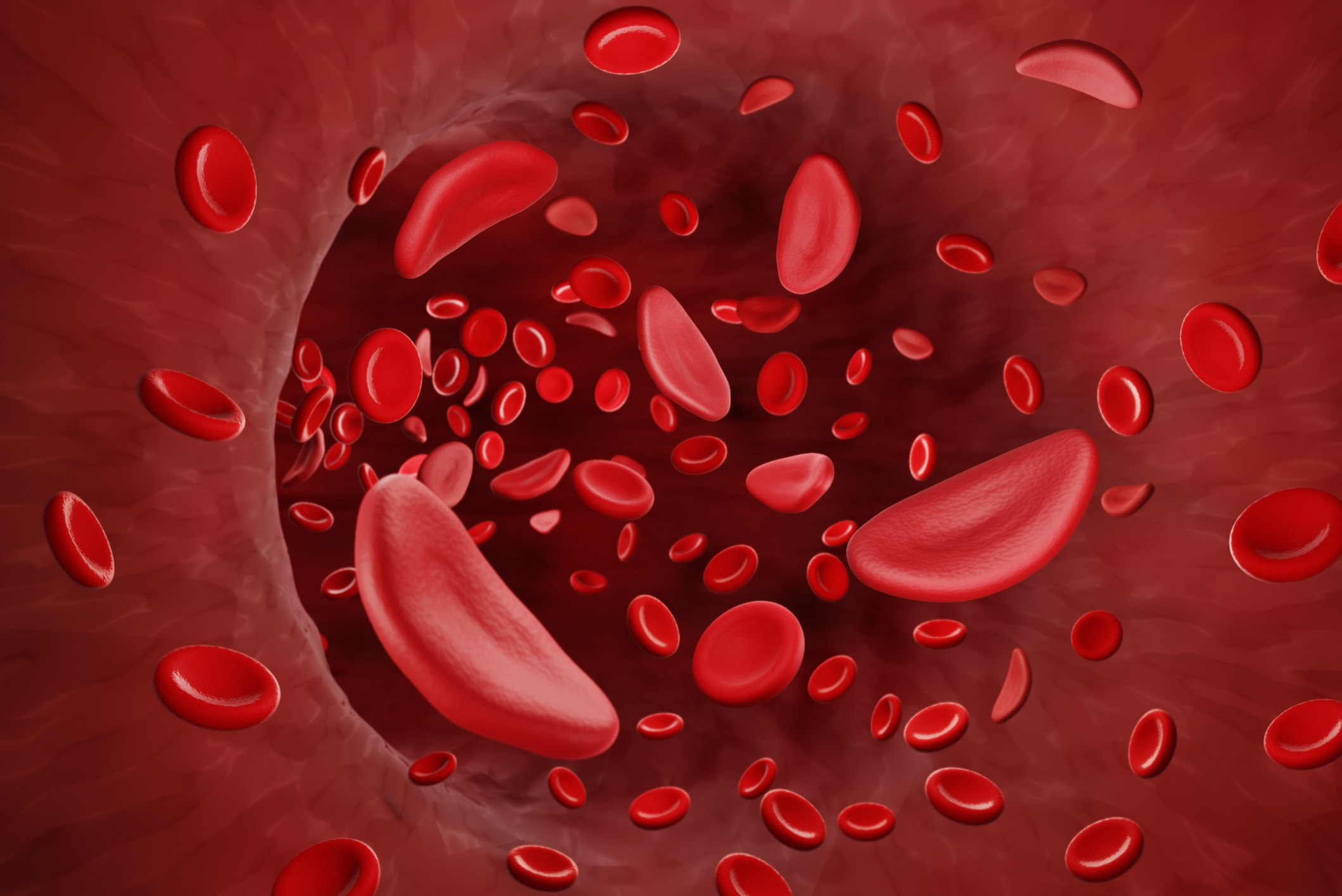 Anemia sideropenica 1 Dietosystem Academy - Anemia sideropenica